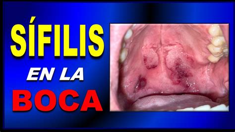 sifilis llagas en la boca-4